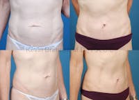 Tummy Tuck Before & After Gallery - Patient 1482457 - Image 1