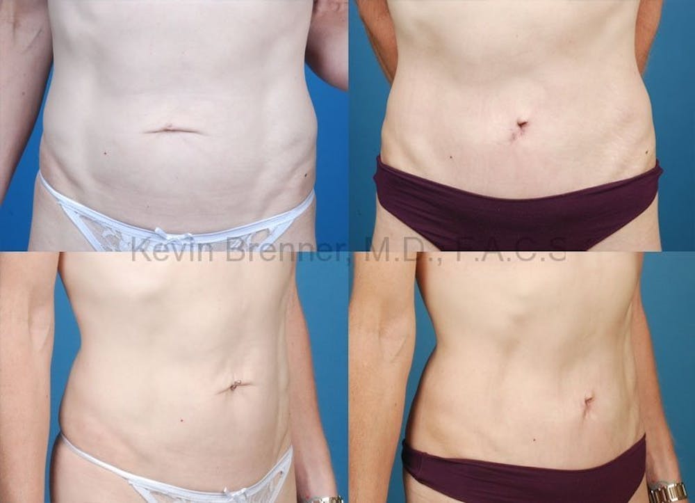 Tummy Tuck Before & After Gallery - Patient 1482457 - Image 1