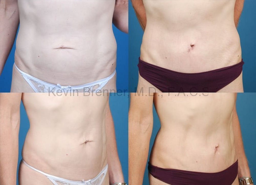 Tummy Tuck Gallery - Patient 1482457 - Image 1