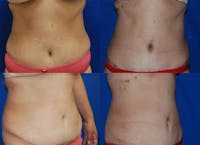 Tummy Tuck Before & After Gallery - Patient 1482459 - Image 1
