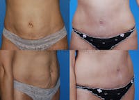 Umbilical Hernia Repair Before & After Gallery - Patient 1482460 - Image 1