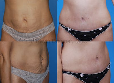 Umbilical Hernia Repair Before & After Gallery - Patient 1482460 - Image 1