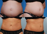Umbilical Hernia Repair Before & After Gallery - Patient 1482462 - Image 1
