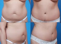 Tummy Tuck Before & After Gallery - Patient 1482463 - Image 1