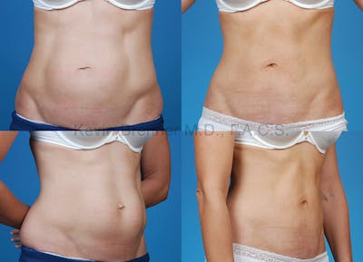 Tummy Tuck Before & After Gallery - Patient 1482465 - Image 1