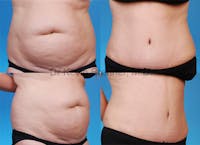 Tummy Tuck Before & After Gallery - Patient 1482467 - Image 1
