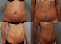 Tummy Tuck Before & After Gallery - Patient 1482469 - Image 1