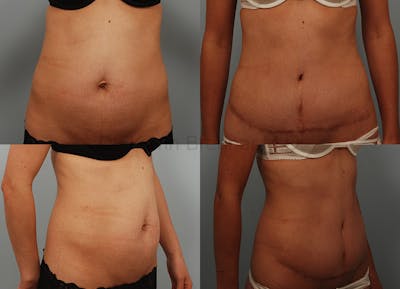 Tummy Tuck Before & After Gallery - Patient 1482469 - Image 1