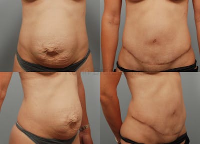 Tummy Tuck Before & After Gallery - Patient 1482470 - Image 1