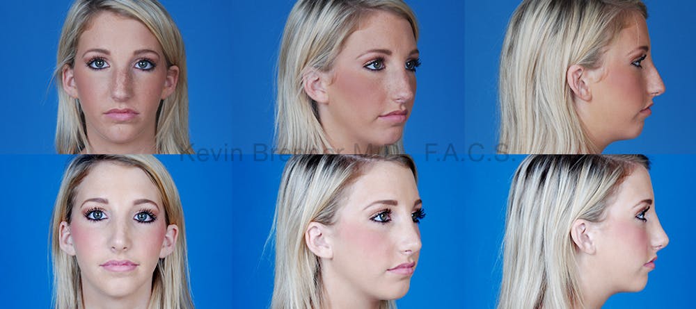 Before and after of beverly hills nose job patient 4