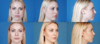 Before and after of beverly hills rhinoplasty patient 5