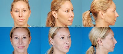 Rhinoplasty Before & After Gallery - Patient 1482549 - Image 1