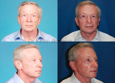Facial Rejuvenation Before & After Gallery - Patient 1482548 - Image 1