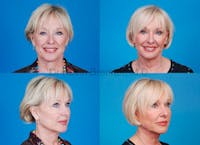 Facial Rejuvenation Before & After Gallery - Patient 1482551 - Image 1