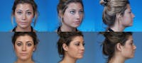 Rhinoplasty Before & After Gallery - Patient 1482550 - Image 1