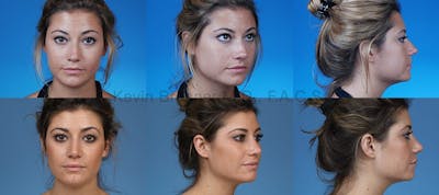 Rhinoplasty Before & After Gallery - Patient 1482550 - Image 1