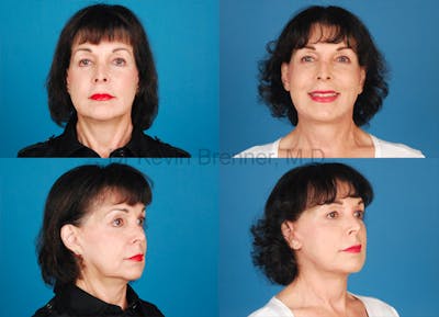 Results from a facelift in Beverly Hills
