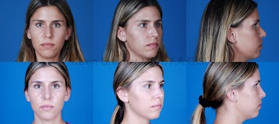 Before and after of beverly hills rhinoplasty patient 3