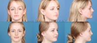 Rhinoplasty Before & After Gallery - Patient 1482554 - Image 1