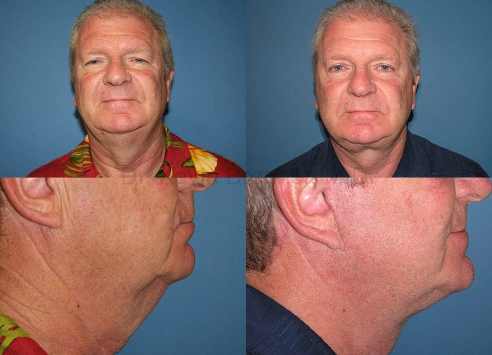 Facial Rejuvenation Before & After Gallery - Patient 1482555 - Image 1
