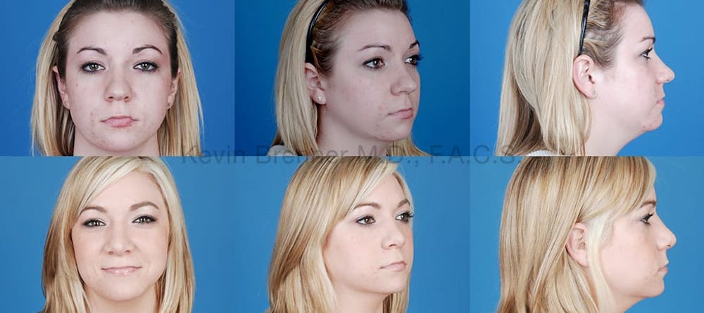 Rhinoplasty Before & After Gallery - Patient 1482556 - Image 1