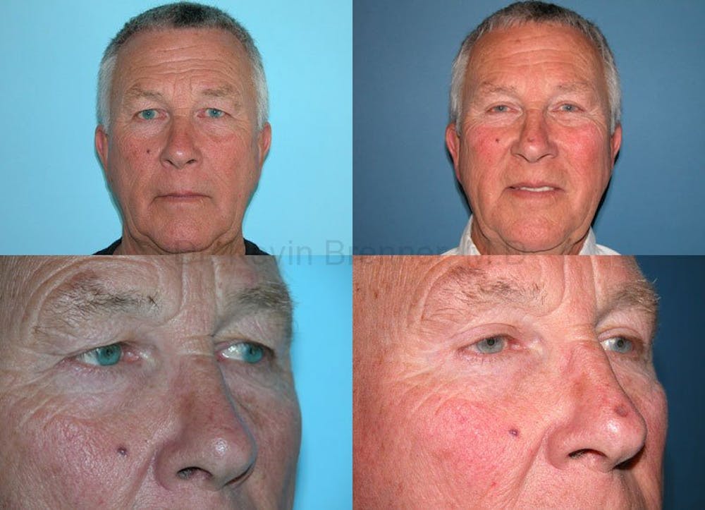 Facial Rejuvenation Before & After Gallery - Patient 1482558 - Image 1