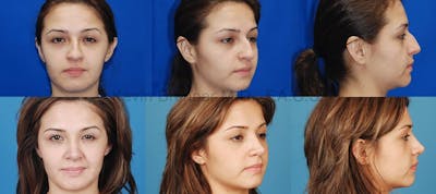 Before and after of beverly hills nose job patient 2