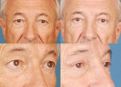 Eyelid Surgery Before & After Gallery - Patient 1482560 - Image 1