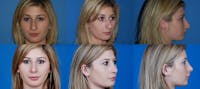 Before and after of beverly hills rhinoplasty patient 1 