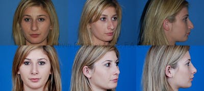 Before and after of beverly hills rhinoplasty patient 1 