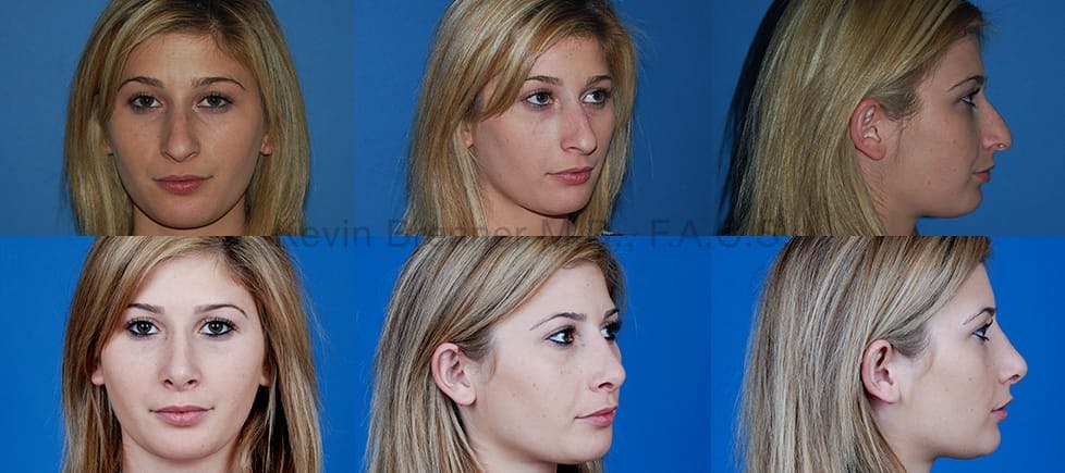 Before and after of beverly hills rhinoplasty patient 1 