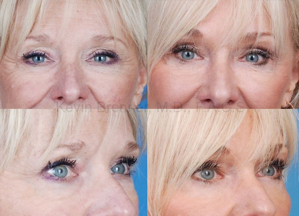 Eyelid Surgery Gallery - Patient 1482562 - Image 1