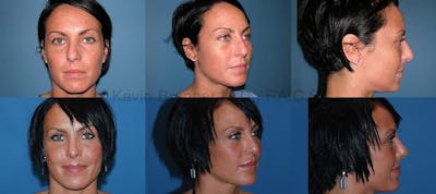 Rhinoplasty Before & After Gallery - Patient 1482563 - Image 1