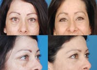 Eyelid Surgery Before & After Gallery - Patient 1482564 - Image 1