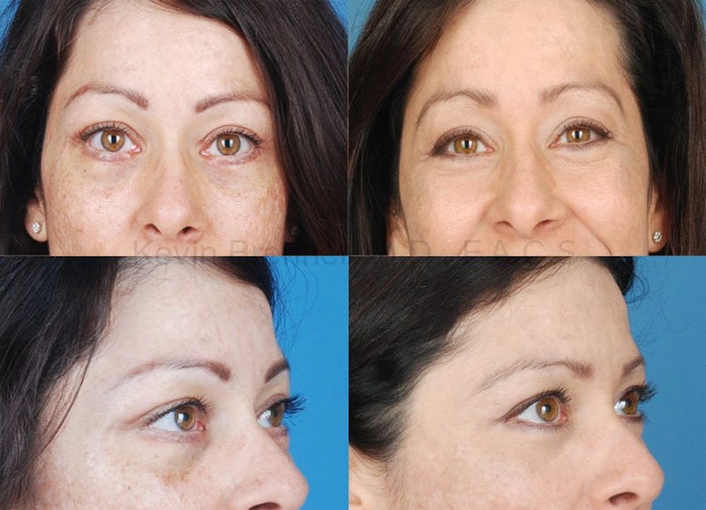 Eyelid Surgery Before & After Gallery - Patient 1482564 - Image 1