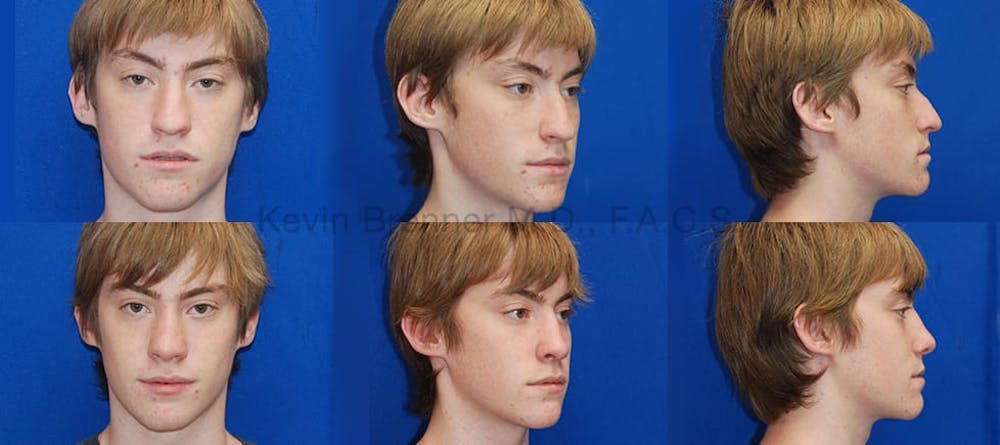 Rhinoplasty Before & After Gallery - Patient 1482565 - Image 1