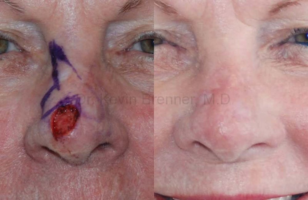 Skin Cancer Reconstruction Gallery - Patient 1482566 - Image 1