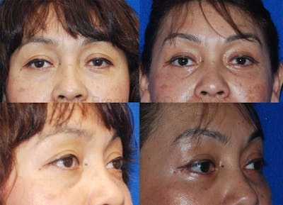 Eyelid Surgery Before & After Gallery - Patient 1482567 - Image 1