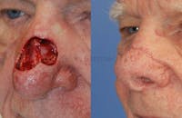 Skin Cancer Reconstruction Before & After Gallery - Patient 1482568 - Image 1