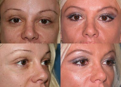 Eyelid Surgery Before & After Gallery - Patient 1482570 - Image 1