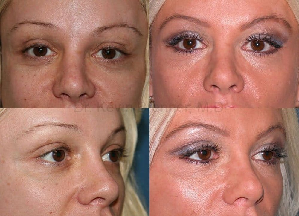 Eyelid Surgery Before & After Gallery - Patient 1482570 - Image 1