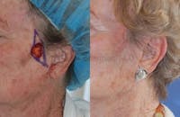 Skin Cancer Reconstruction Before & After Gallery - Patient 1482571 - Image 1