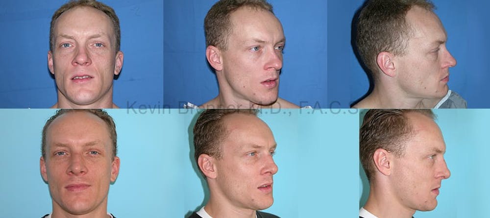 Rhinoplasty Before & After Gallery - Patient 1482572 - Image 1