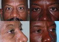 Eyelid Surgery Before & After Gallery - Patient 1482573 - Image 1