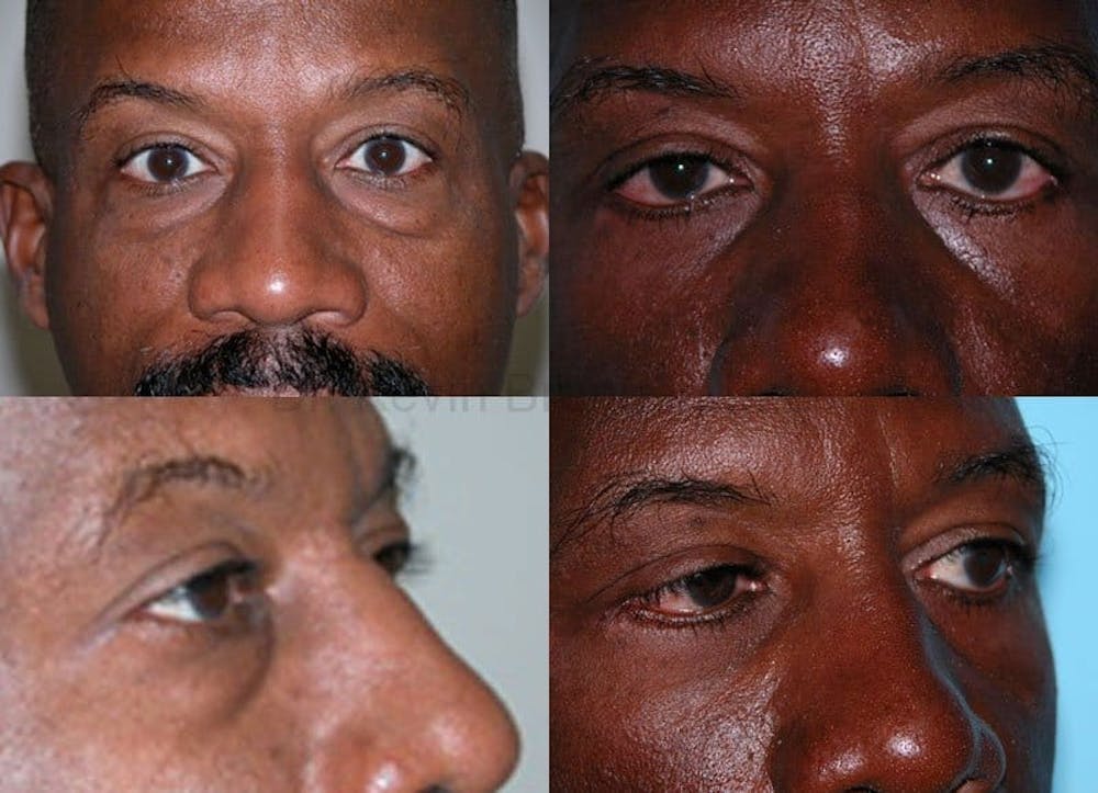 Eyelid Surgery Gallery - Patient 1482573 - Image 1
