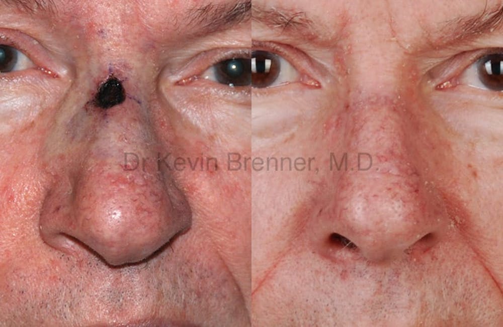 Skin Cancer Reconstruction Before & After Gallery - Patient 1482574 - Image 1