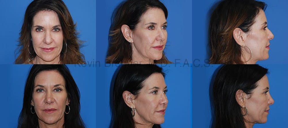 Rhinoplasty Before & After Gallery - Patient 1482575 - Image 1