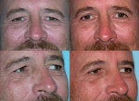 Eyelid Surgery Before & After Gallery - Patient 1482576 - Image 1