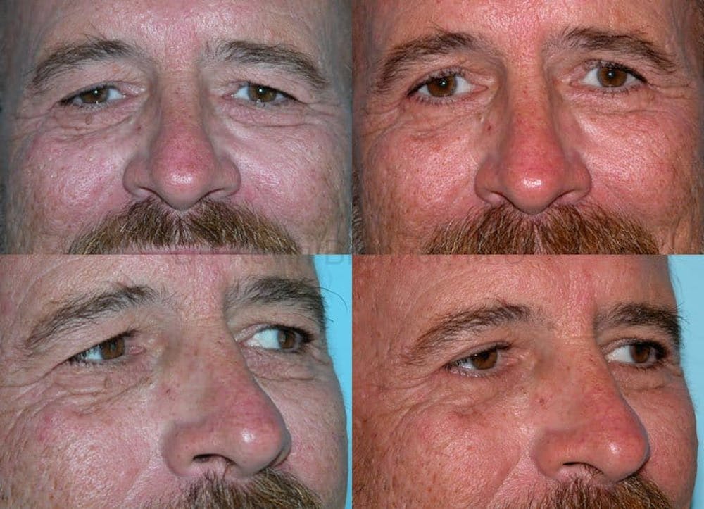 Eyelid Surgery Gallery - Patient 1482576 - Image 1