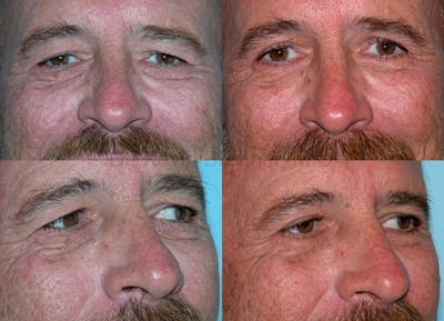 Eyelid Surgery Before & After Gallery - Patient 1482576 - Image 1